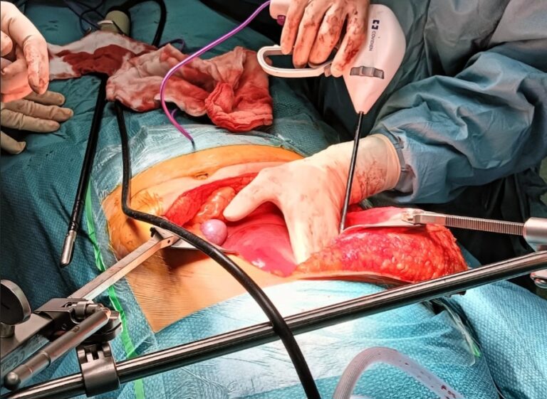 KPJ perform Whipple procedure to remove tumour